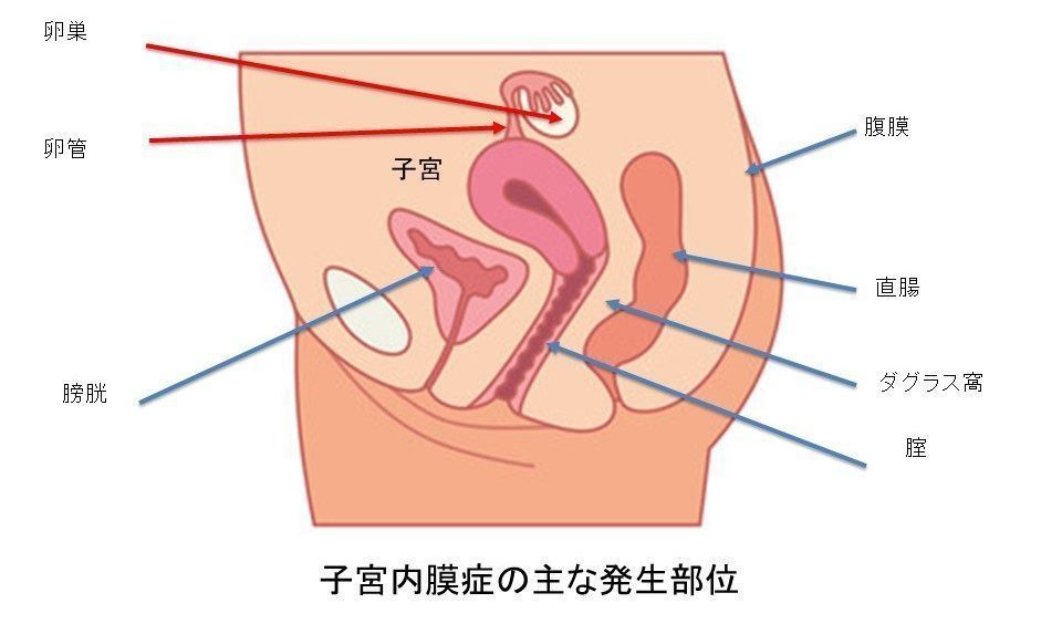 子宮内膜症 公益財団法人東京都医療保健協会 練馬総合病院